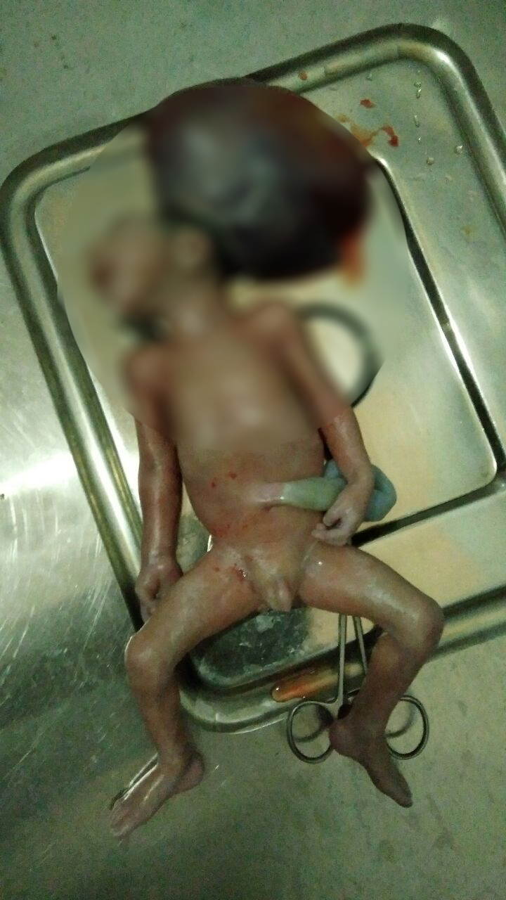 ಕೊಪ್ಪ ಖಾಸಗಿ ಆಸ್ಪತ್ರೆಯಲ್ಲಿ ಅಸಹಜ ಮಗು ಜನನ